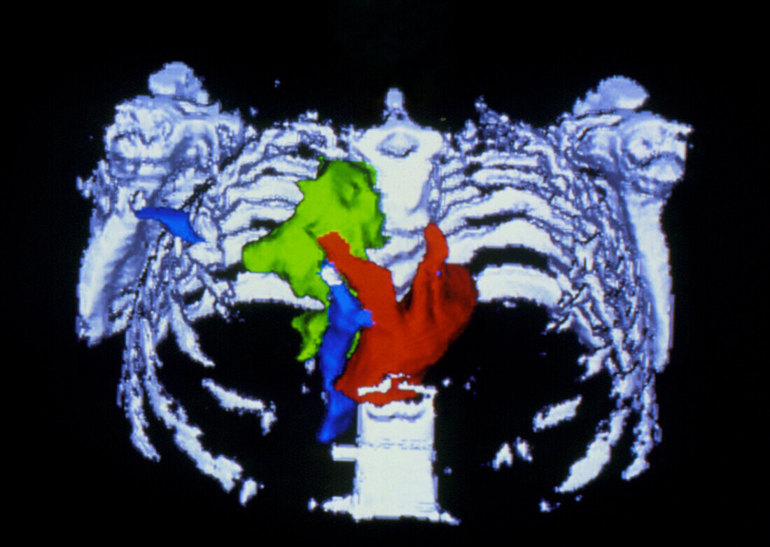 False-colour 3-D CT scan of pancreatic cancer