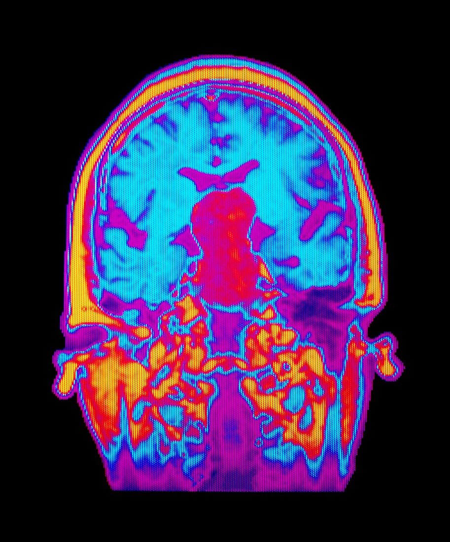 Coloured MRI brain scan: pituitary adenoma