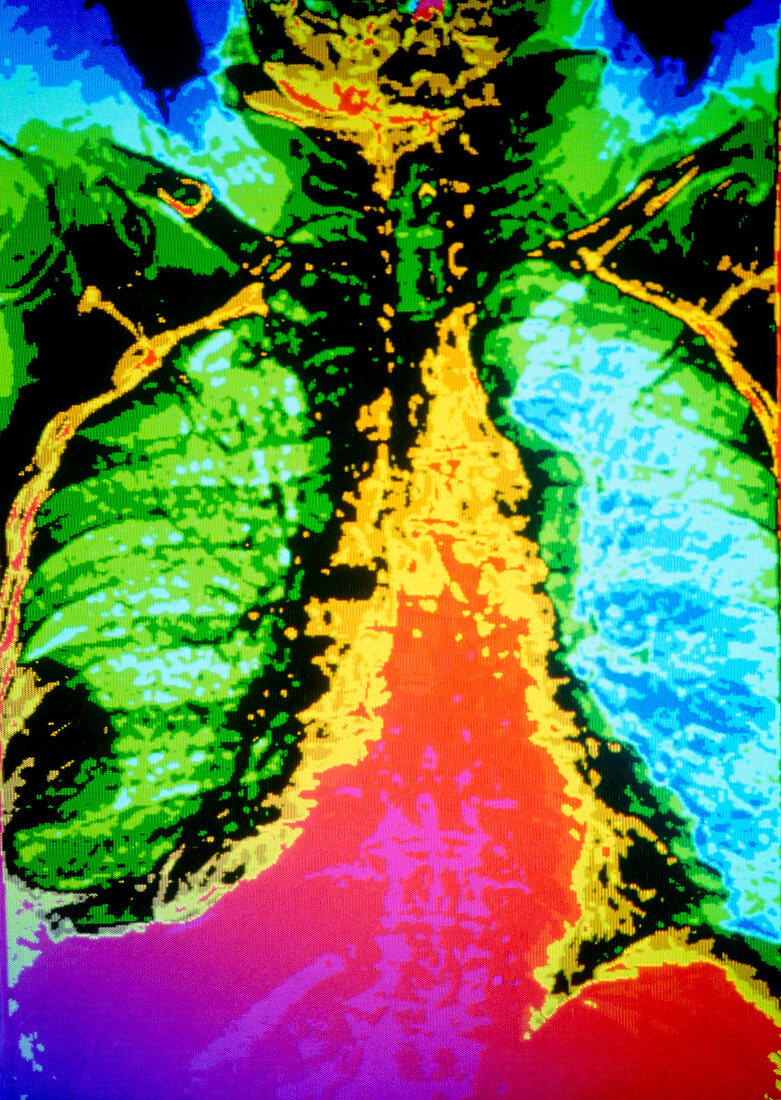 Coloured CT scan showing cancer of lung