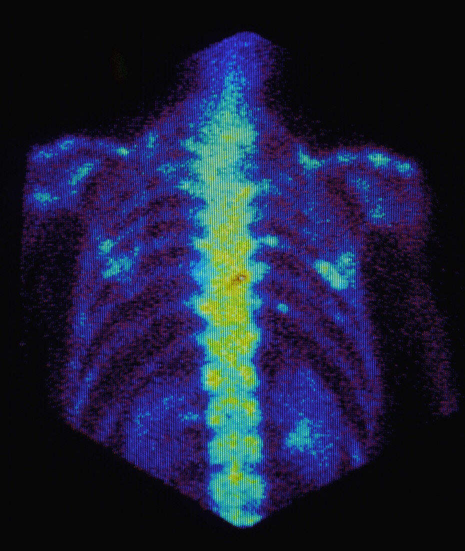 F/col gamma scan of metastatic bone cancer in ribs