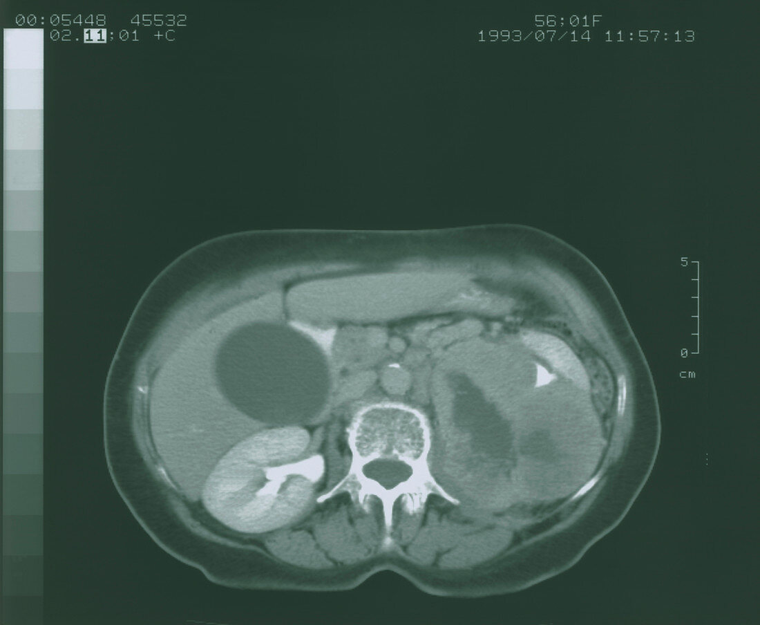 CT scan showing kidney cancer (axial section)