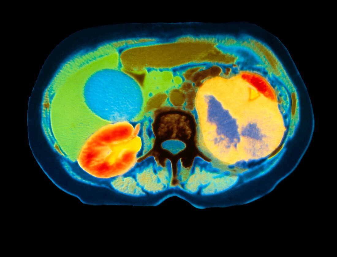 Col CT scan showing kidney cancer (axial section)