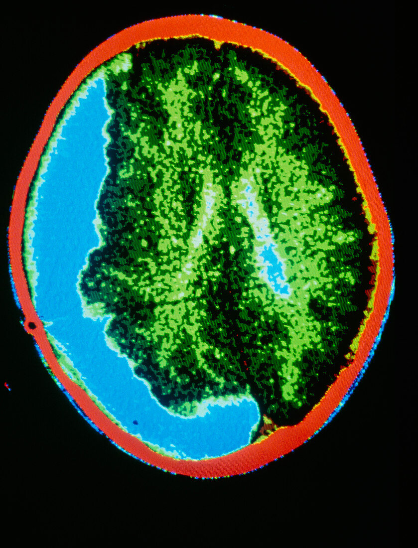Coloured MRI scan of big pituitary adenoma tumour