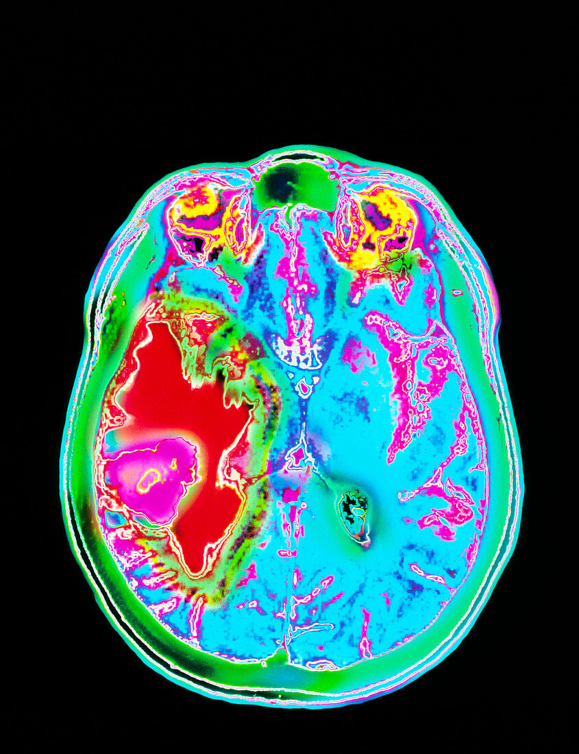 MRI scan of a metastatic brain tumour