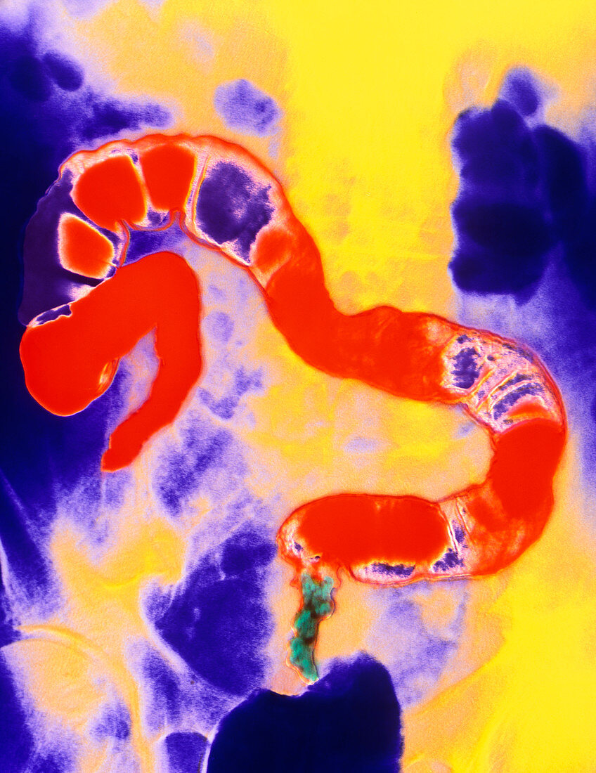 Coloured X-ray of the colon showing rectal cancer