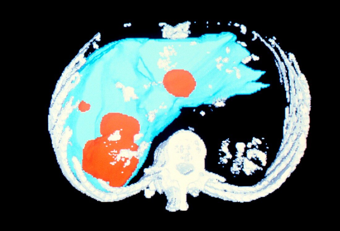 Coloured 3-D CT scan of metastatic liver cancer