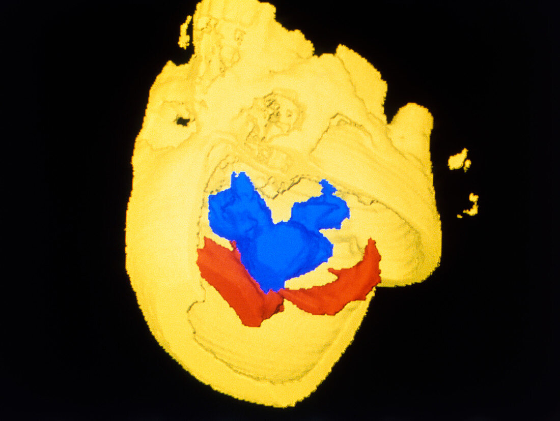 Coloured 3-D CT scan of glioblastoma brain tumour