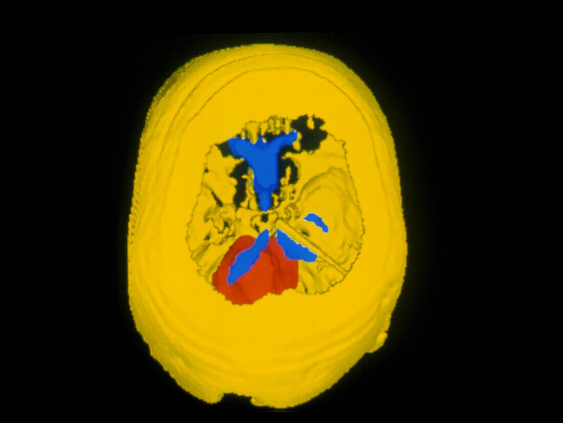 3-D CT scan of medulloblastoma brain tumour
