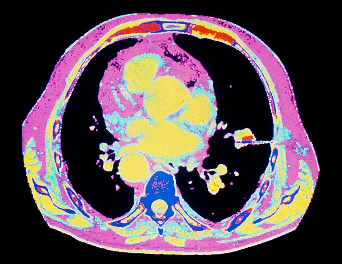 Computed tomography scan of lung cancer biopsy