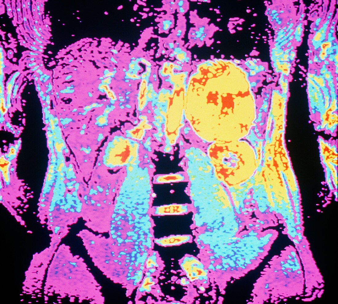 Coloured MRI scan of kidney cancer