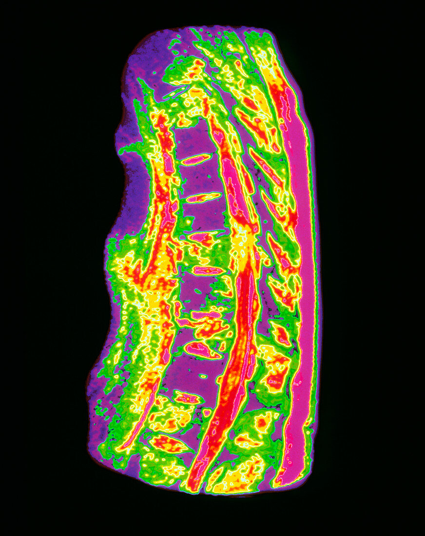 Coloured MRI scan of metastatic cancer of spine