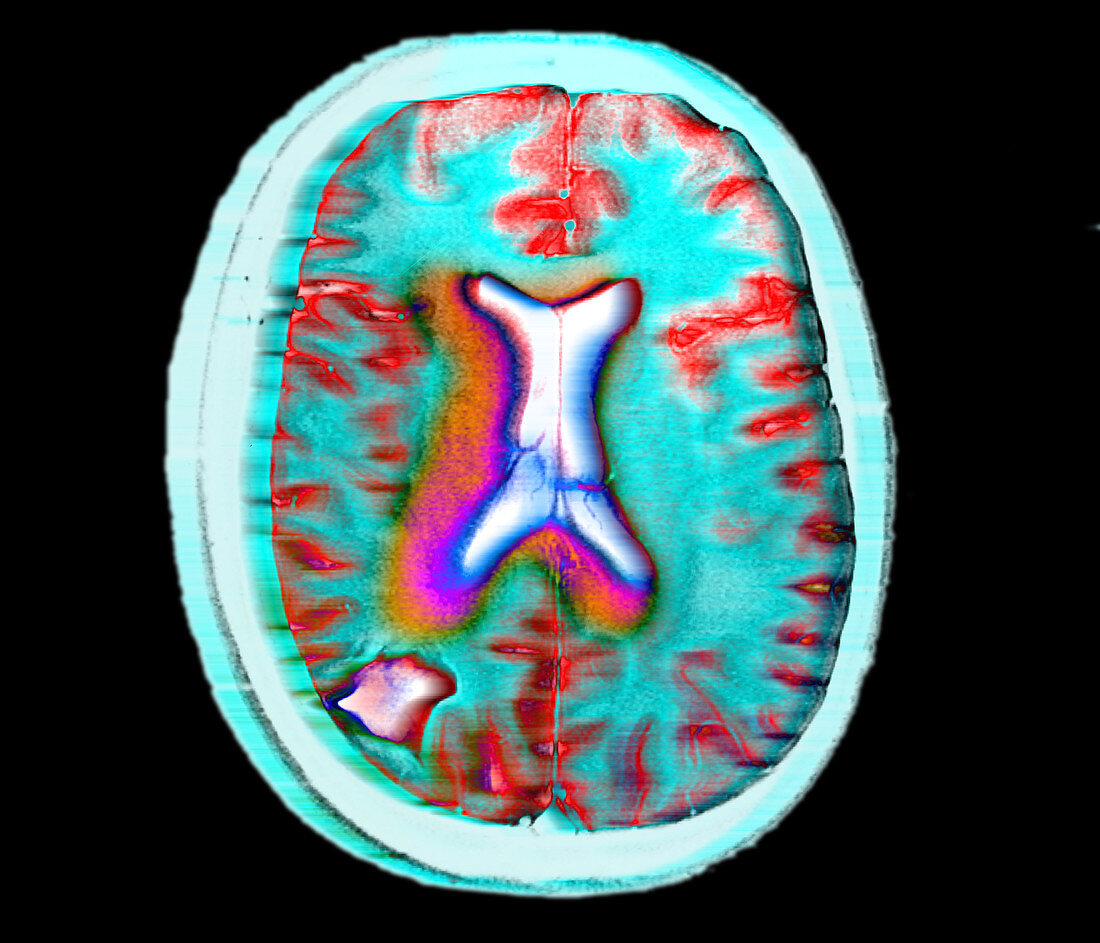 Coloured MRI brain scan showing an area of cancer