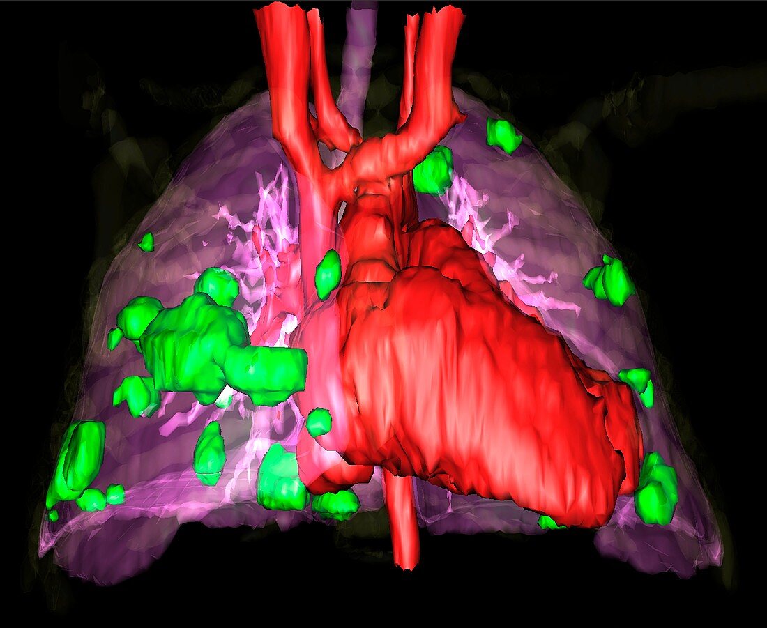 Secondary lung cancers,3D MRI scan