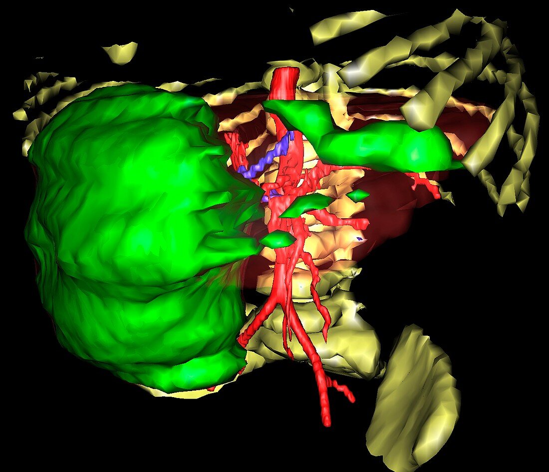 Primary liver cancer,3D MRI scan