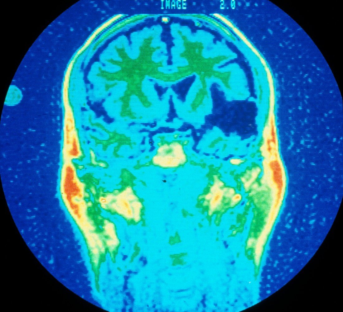 False-col NMR image showing cerebral infarction