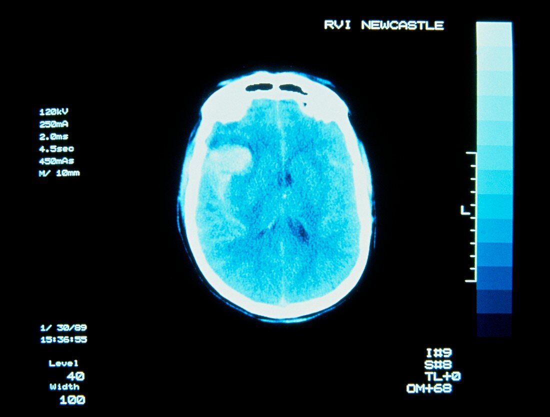 X-ray tomography scan of brain showing haemorrhage
