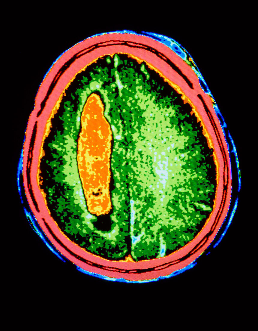 F/col CT scan of brain haemorrhage (intraventric.)