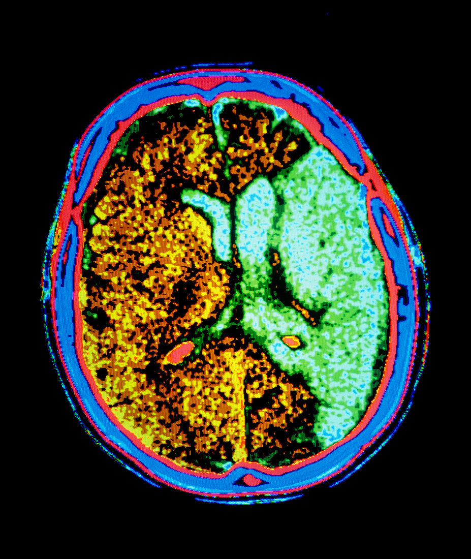 CT scan of brain with cerebral infarction