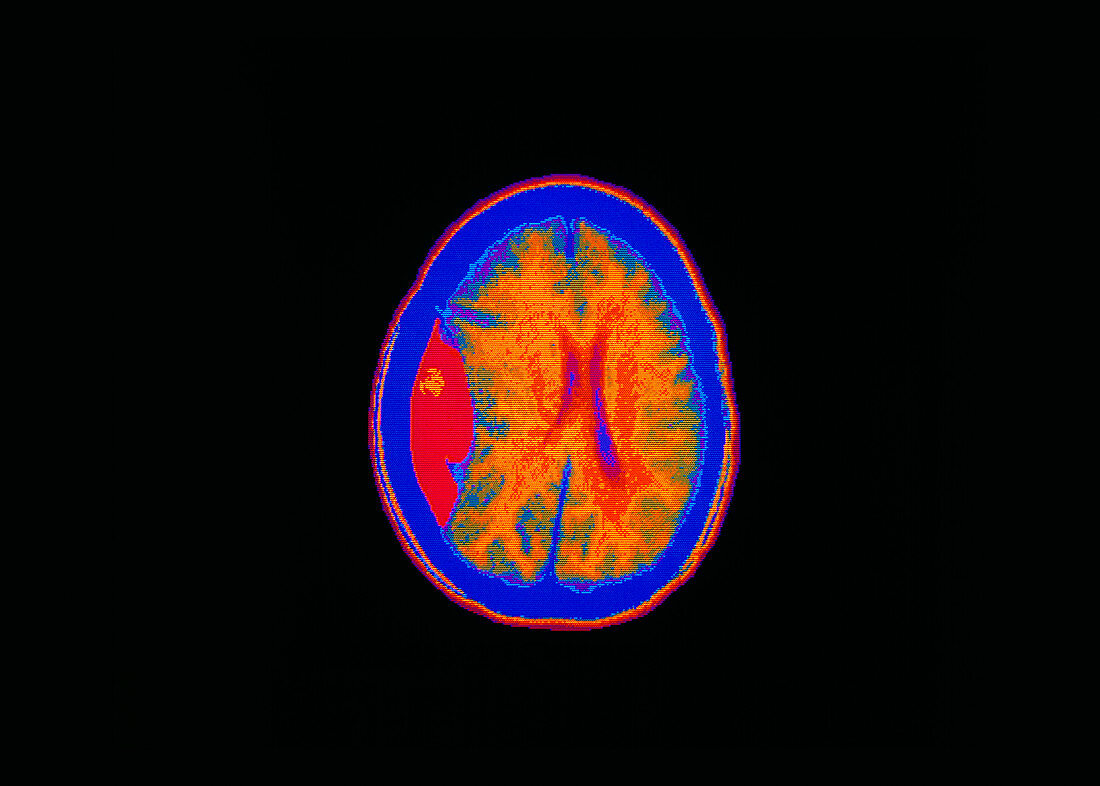 Coloured CT scan showing a brain haemorrhage