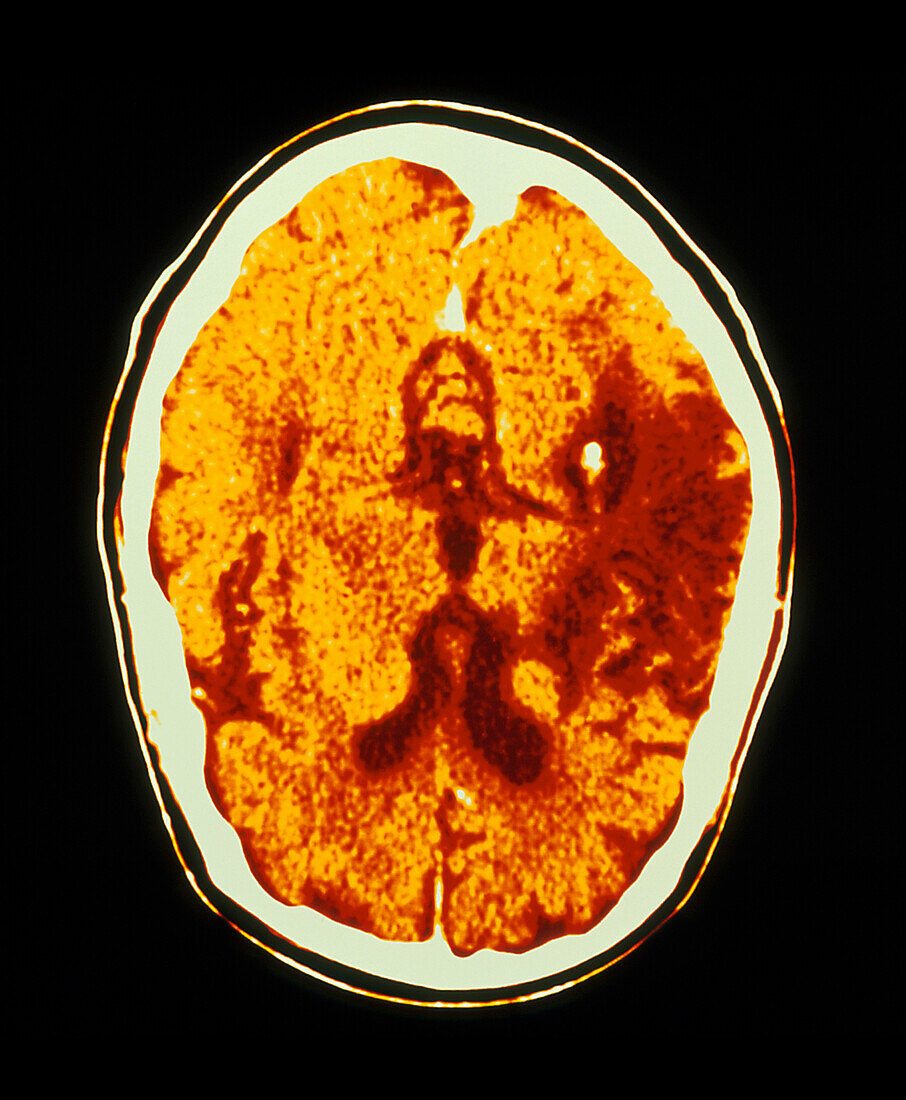 Coloured CT scan of the brain showing a stroke