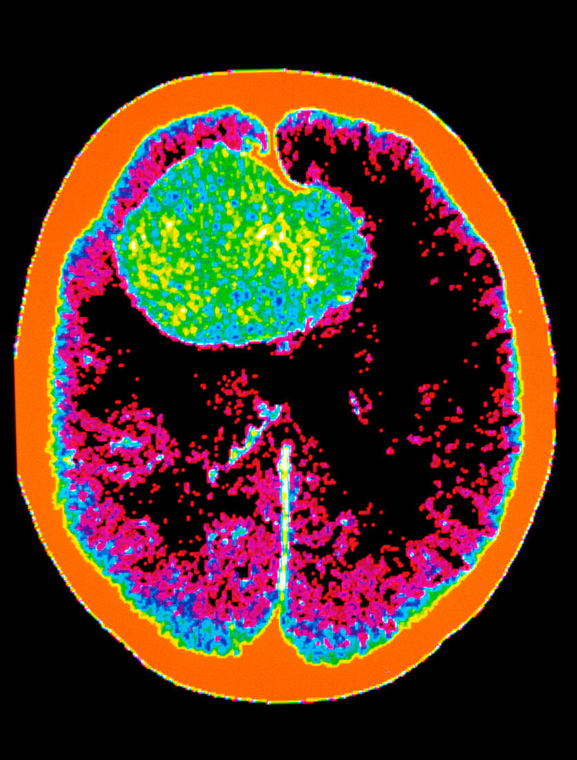 CT scan: brain haemorrhage from cerebral aneurysm