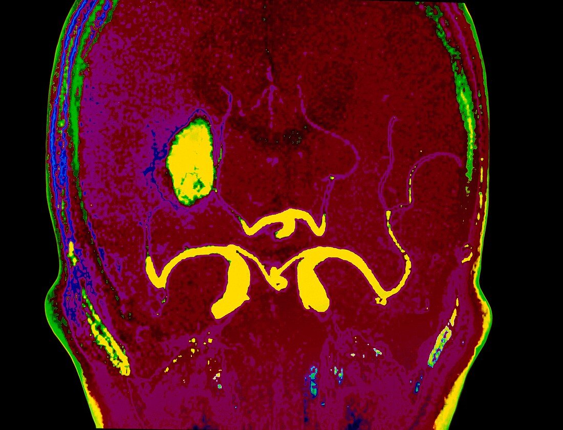 Coloured MRI scan of a cerebral infarction