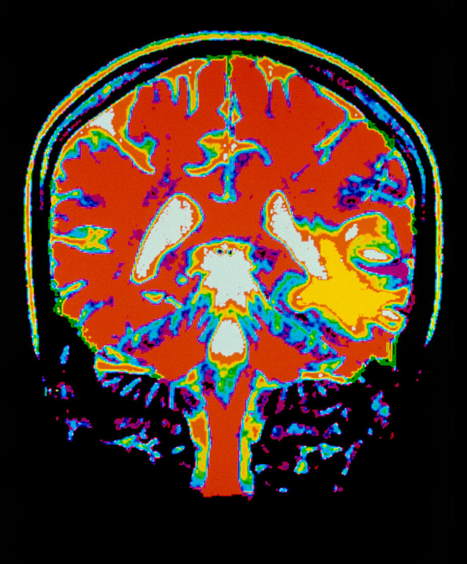 Coloured MRI scan of the brain after a stroke