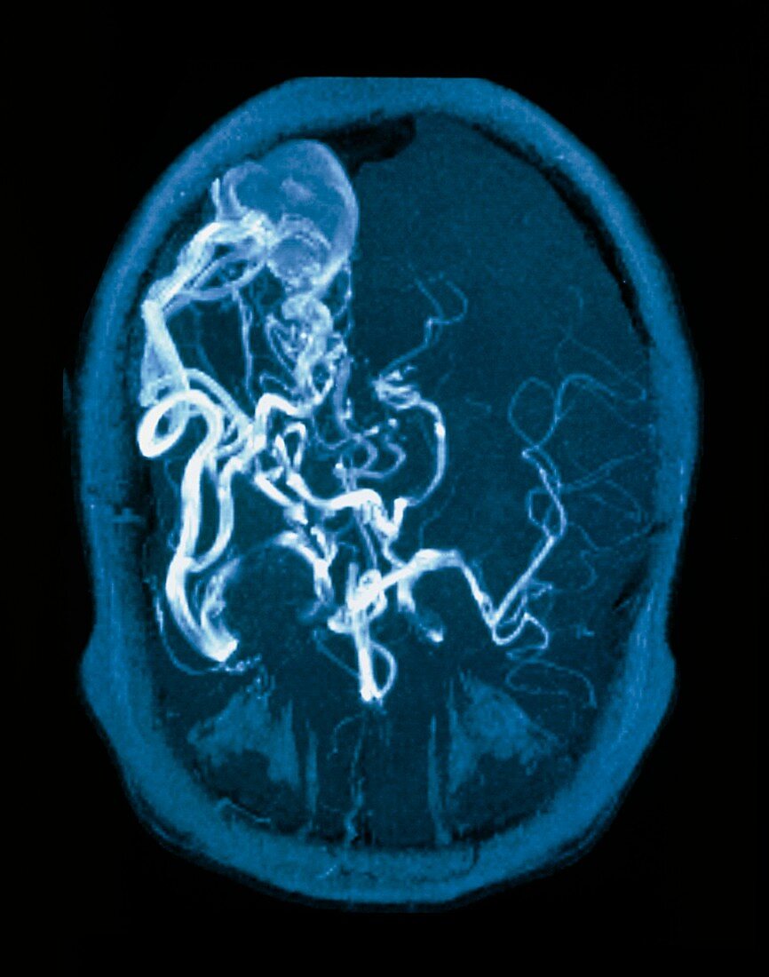MRI scan of brain with arteriovenous malfunction