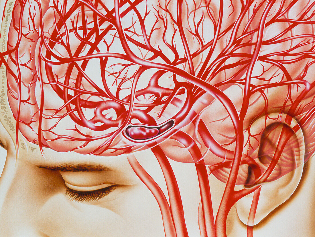 Artwork of cerebral embolism,cause of stroke
