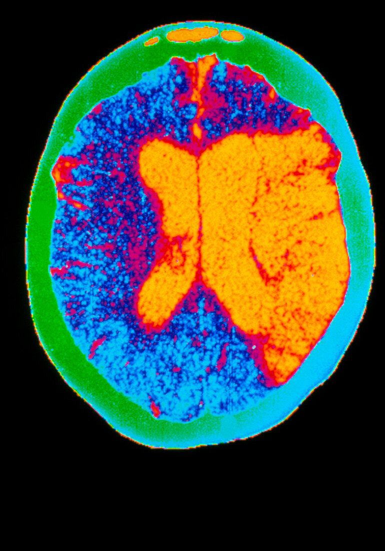 Coloured CT scan of a brain haemorrhage