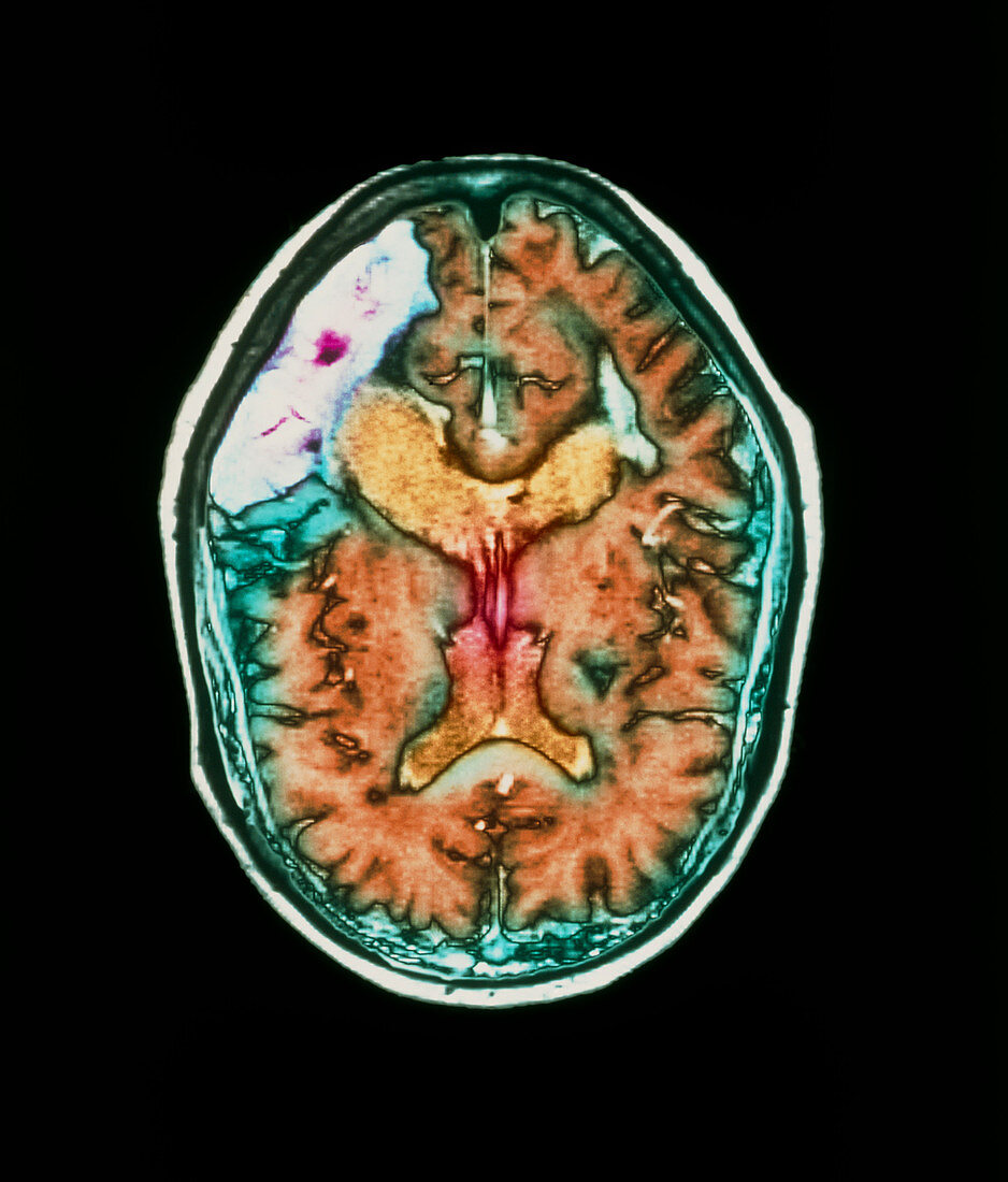 MRI scan of brain stroke