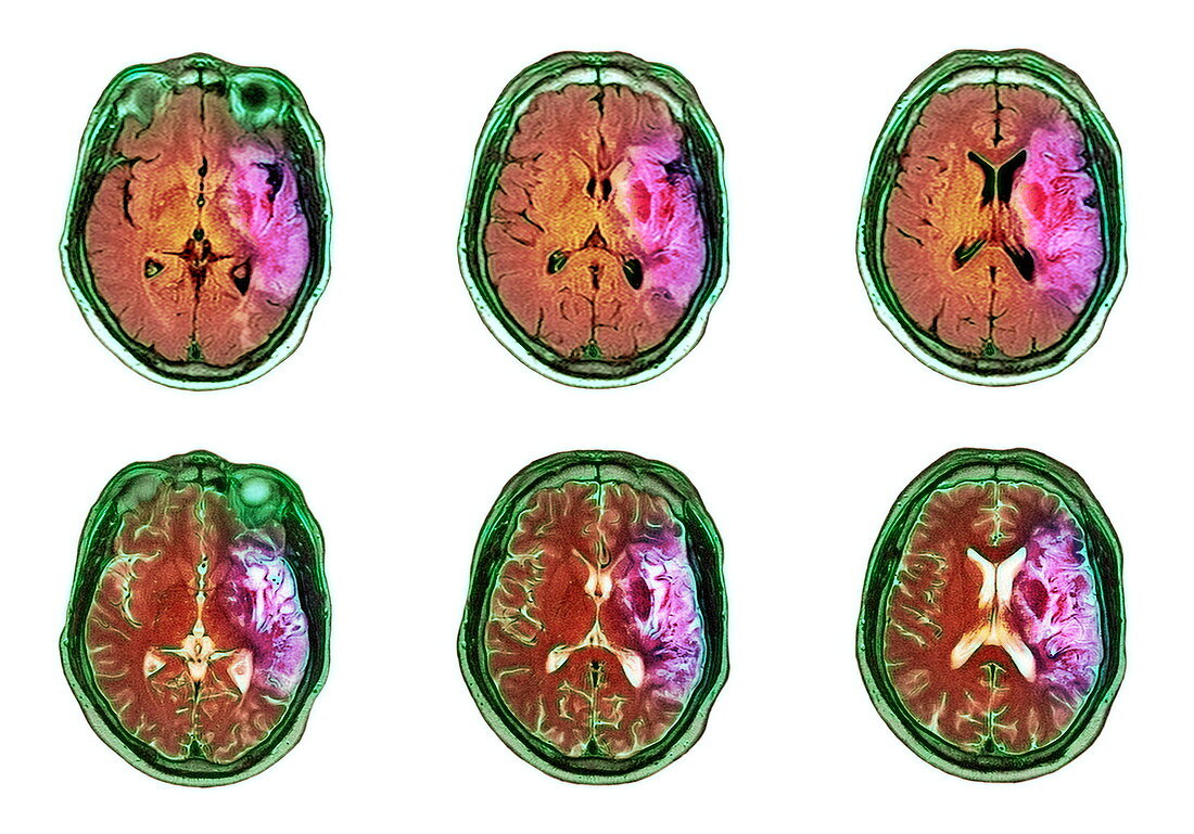 Stroke,CT scan