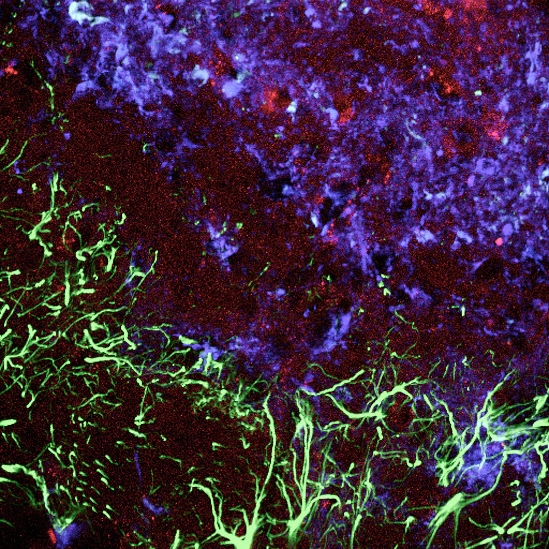 Damaged brain tissue,light micrograph