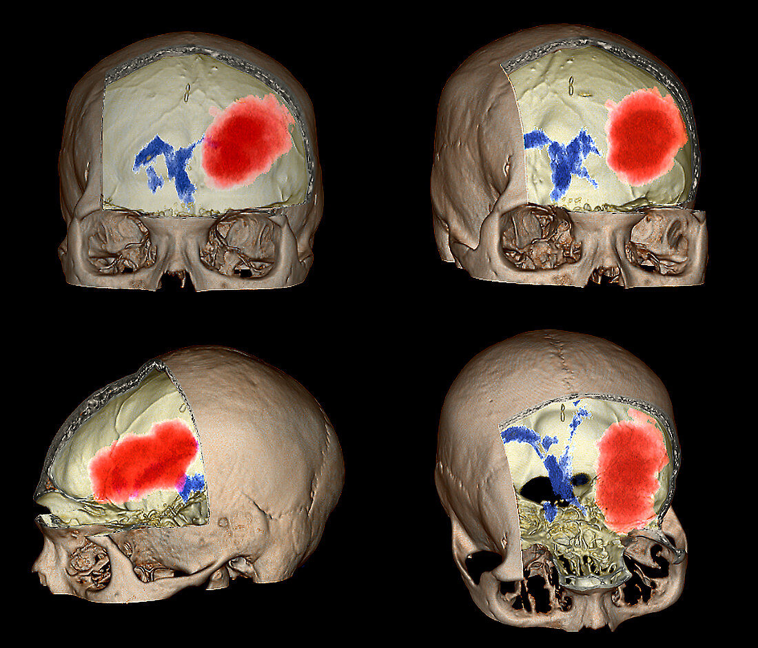 Brain haemorrhage,CT scans