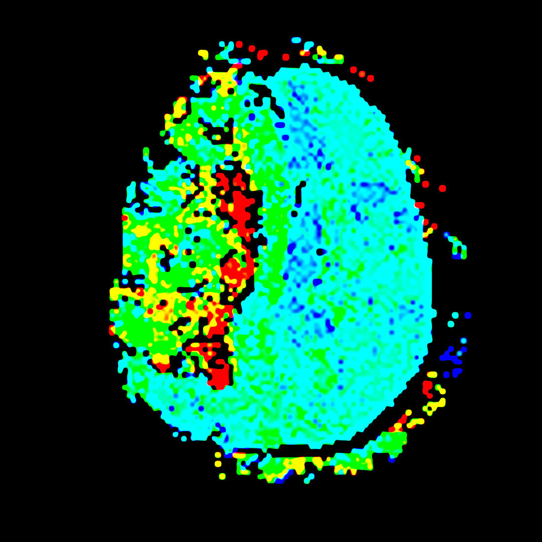 Stroke,fMRI scan