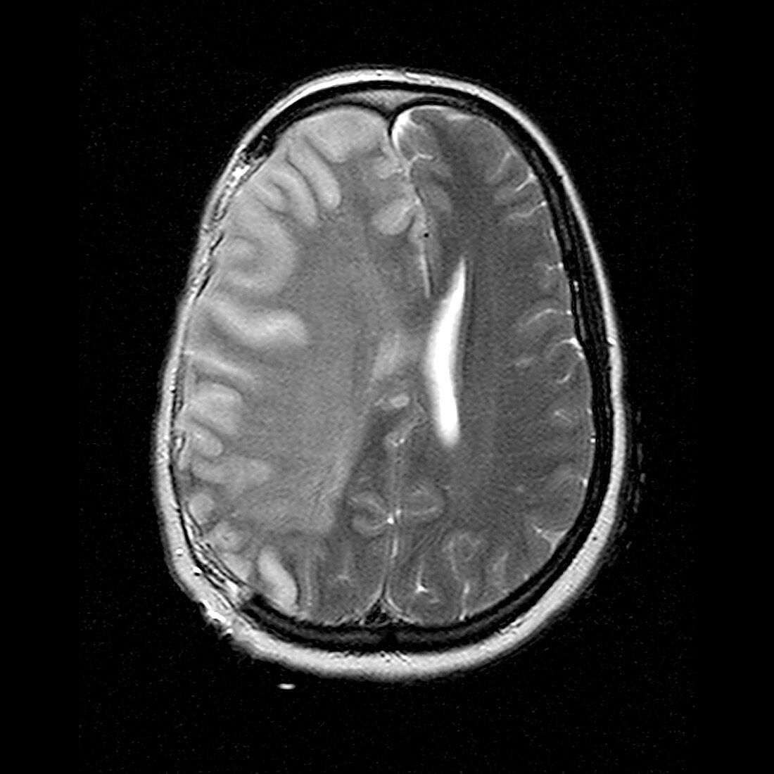 Stroke,MRI scan