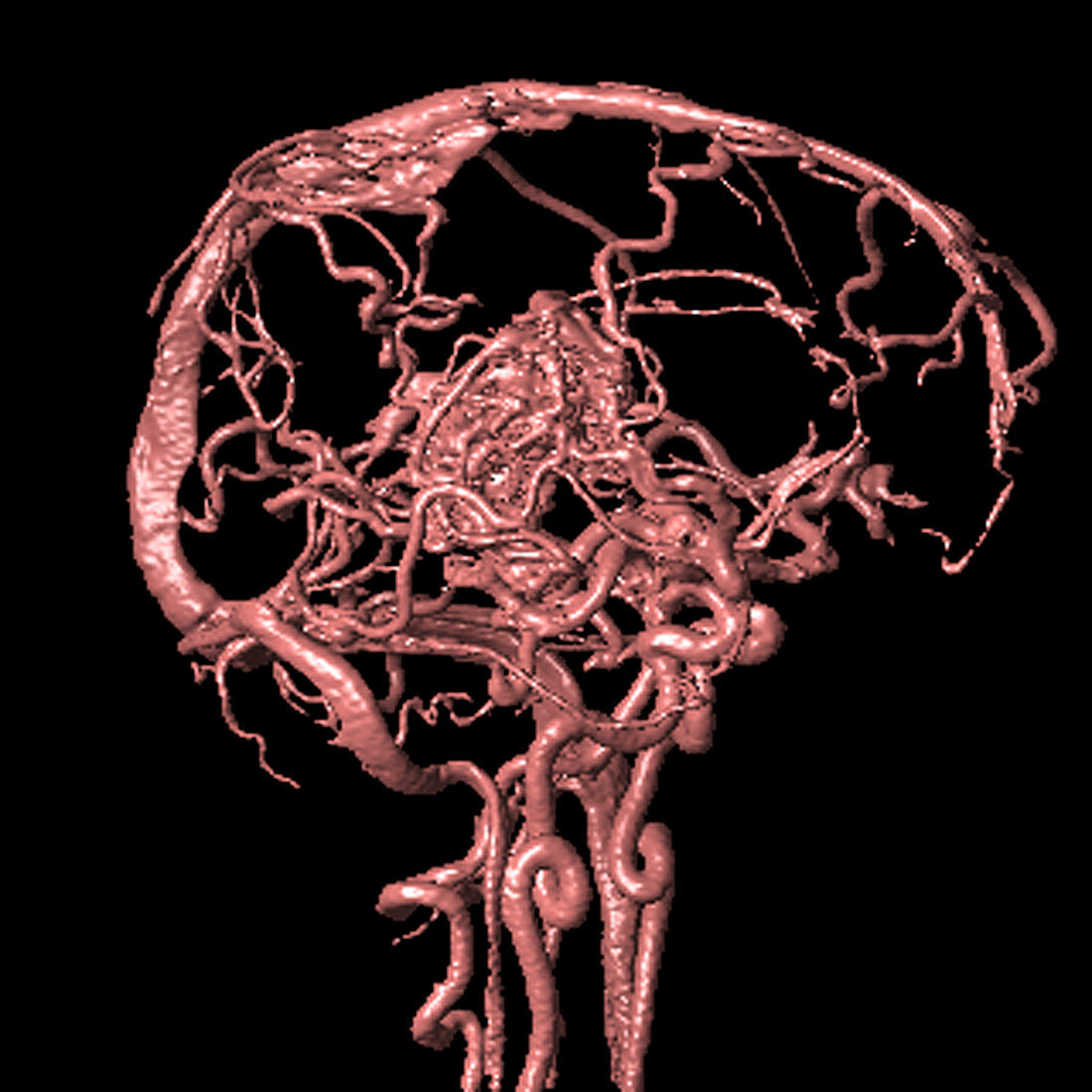 Brain arteriovenous malformation,MRA