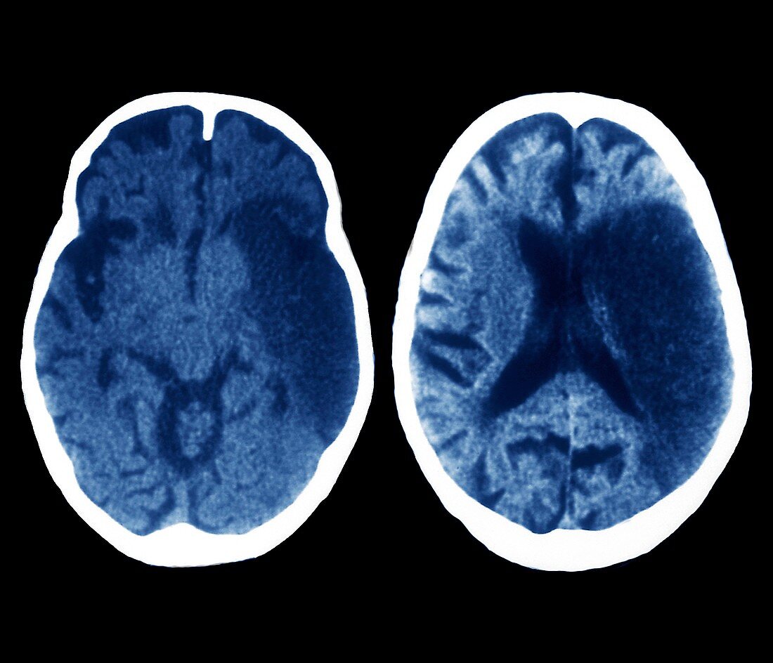 Stroke,CT brain scans