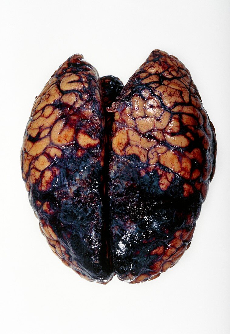 Brain haemorrhage,post-mortem