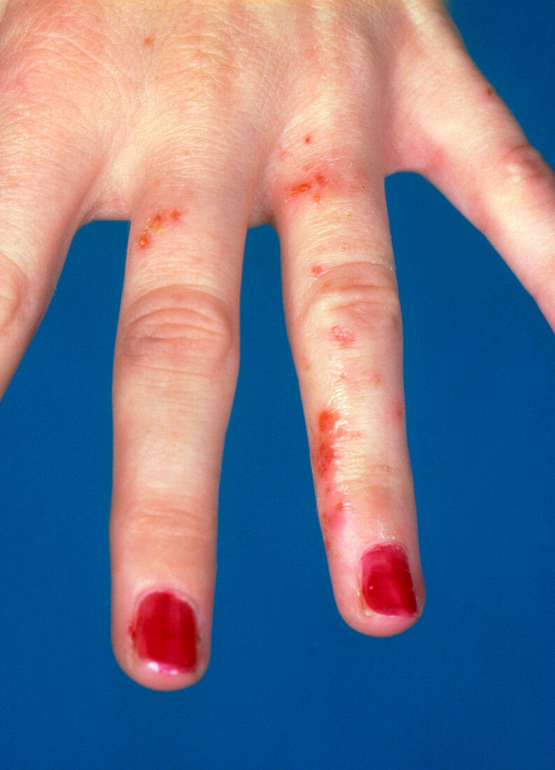 Contact dermatitis between the fingers