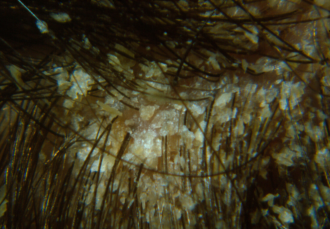 Close-up of human scalp with dandruff