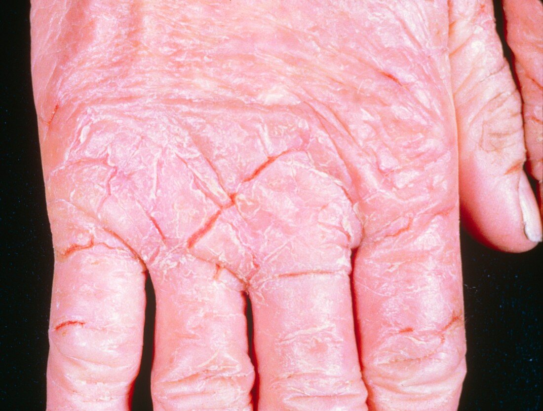 Dermatitis of the hand from rubber gloves