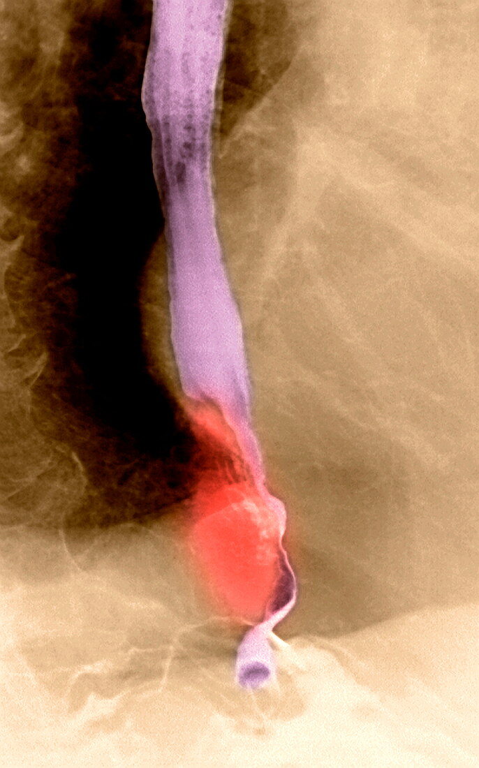 Oesophageal cancer,X-ray