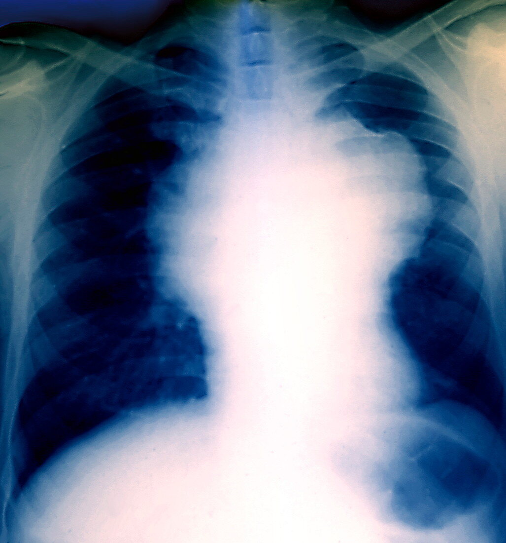 Non-Hodgkin's lymphoma,X-ray