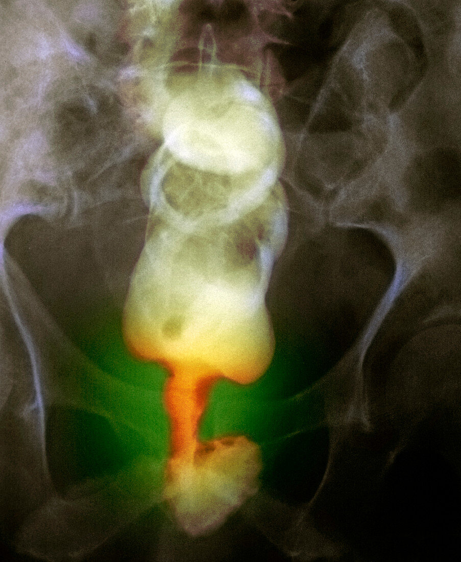 Narrowed rectum,X-ray