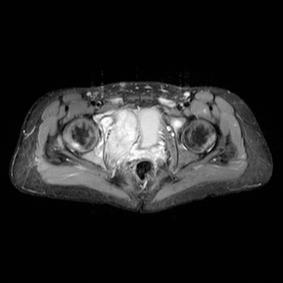 Ewing's sarcoma,MRI scan