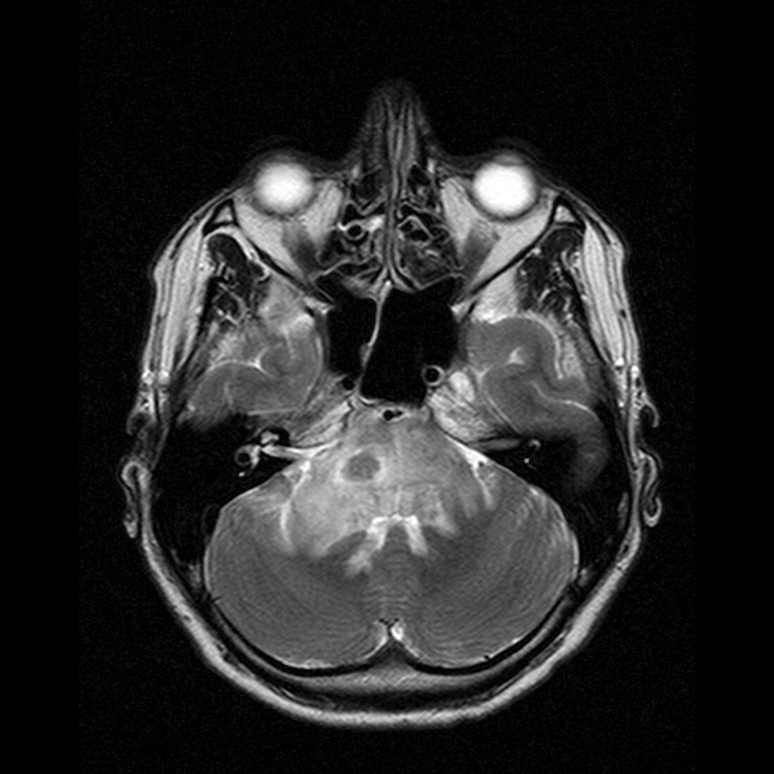 Brain tumour,MRI scan