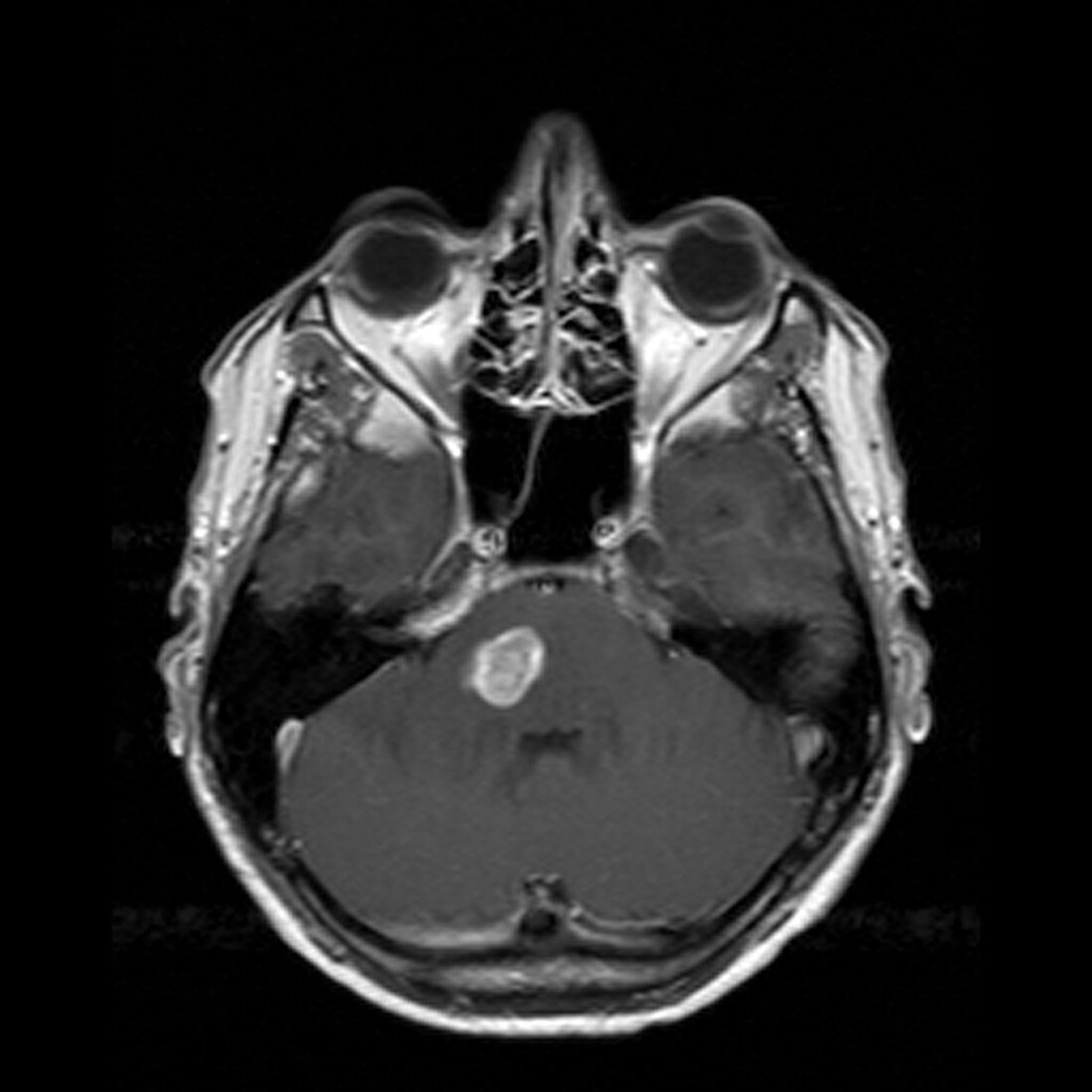 Brain tumour,MRI scan