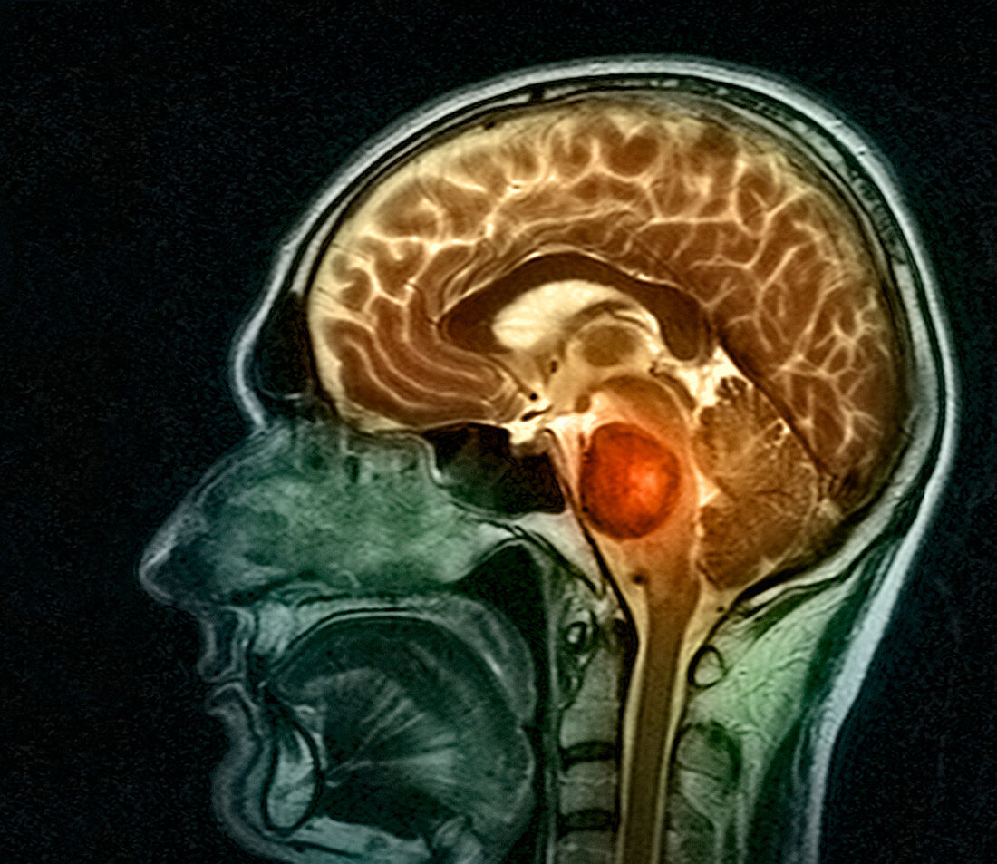 Brain tumour,MRI scan