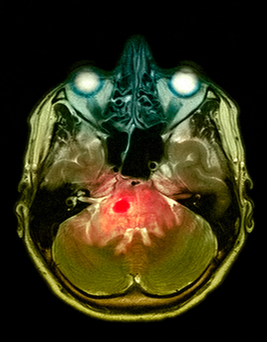 Brain tumour,MRI scan